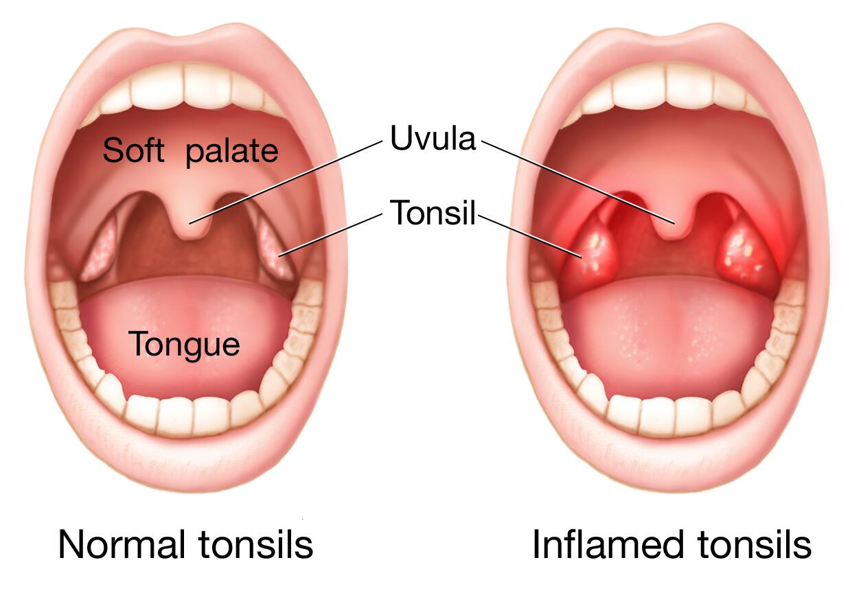 Tonsillitis Beacon Health System